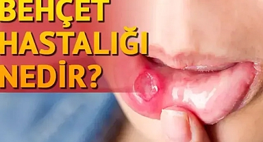Behçet Hastalığı Nedir, Belirtileri Nelerdir?