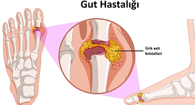 Gut Hastalığı Nedir, Belirtileri Nelerdir?